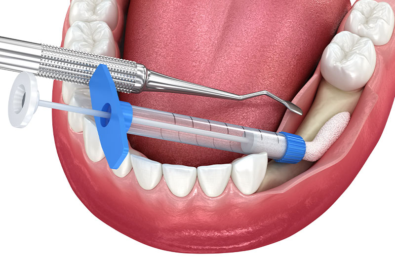 Bone Grafting in Manchester