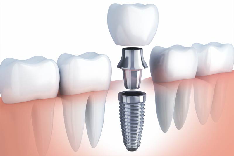 Implants Dentist in Manchester