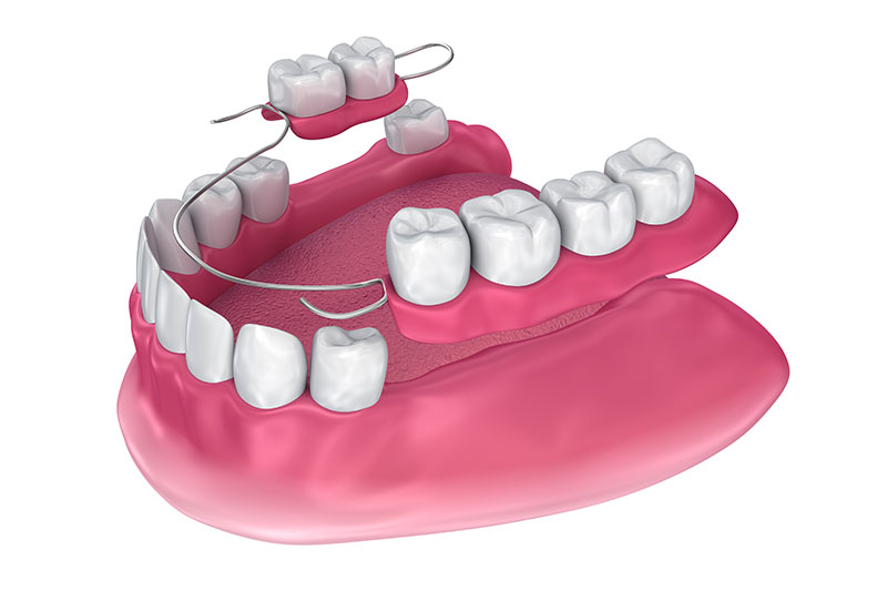 Partial Dentures in Manchester