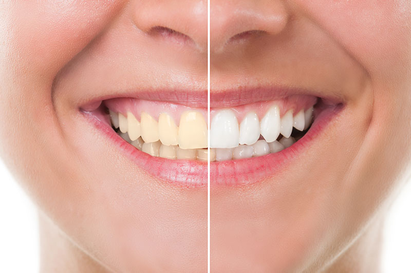 In-Office Teeth Whitening in Manchester