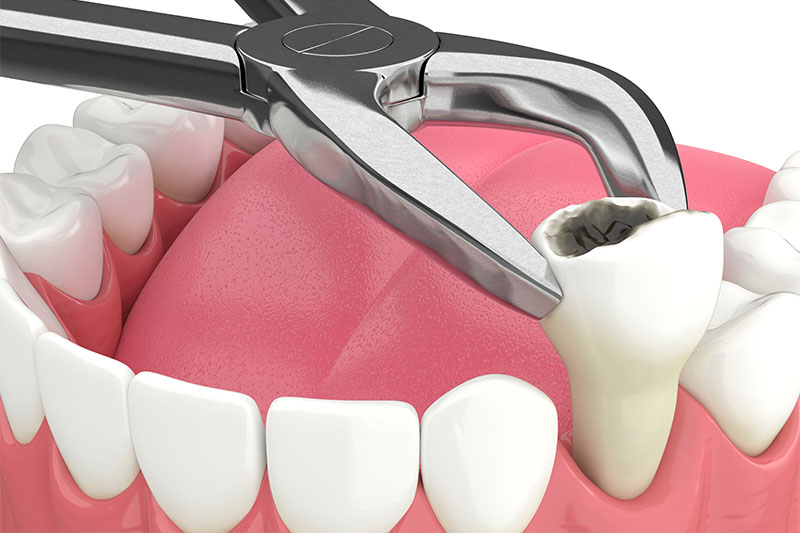 Tooth Extractions in Manchester